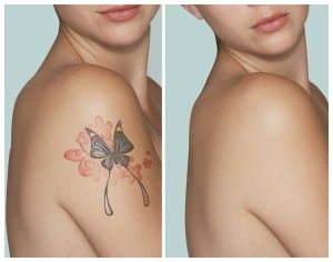 Rimozione tatuaggi