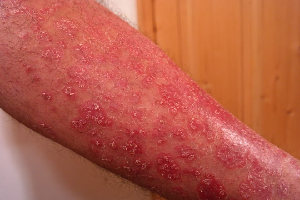 Come curare la psoriasi